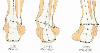 骨科医生提醒：千万别陷入这买鞋5大误区  五步选鞋法、正确量脚长方法